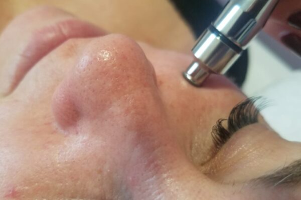 Microdermoabrasion- Punta de diamante (3)